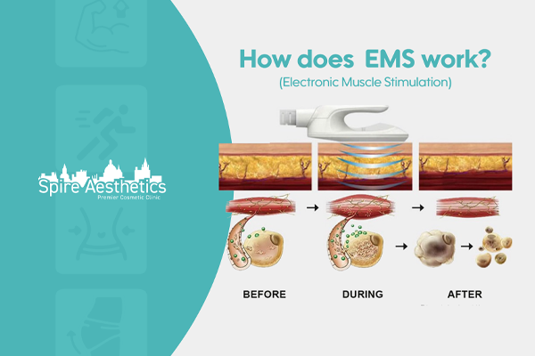 EMS treatment for post pregnancy weight loss treatment Shoreham Beach
