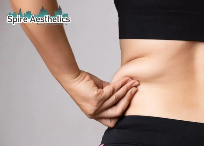 Image of woman pinching fat on their hips Shoreham Beach. Fat Freezing treatment