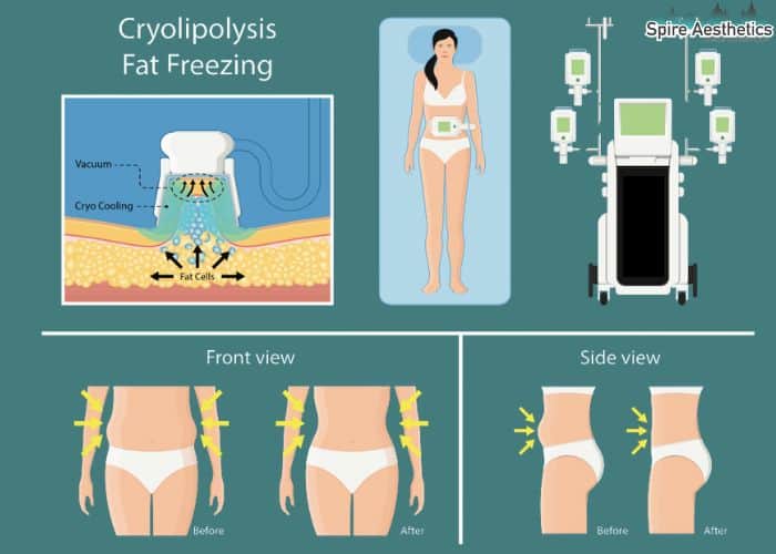 Image of diet and fat freezing combined for best results for Spire Aesthetics Shoreham Beach