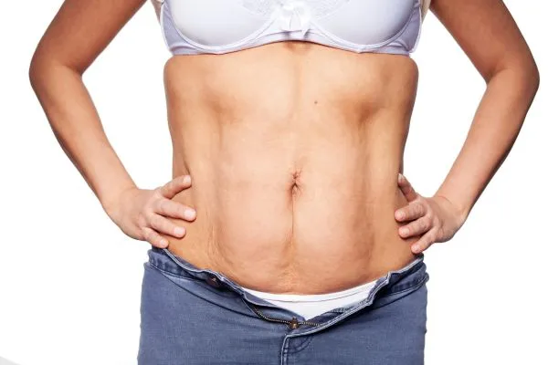 sagging skin on woman's stomach after weight loss injections Shoreham Beach