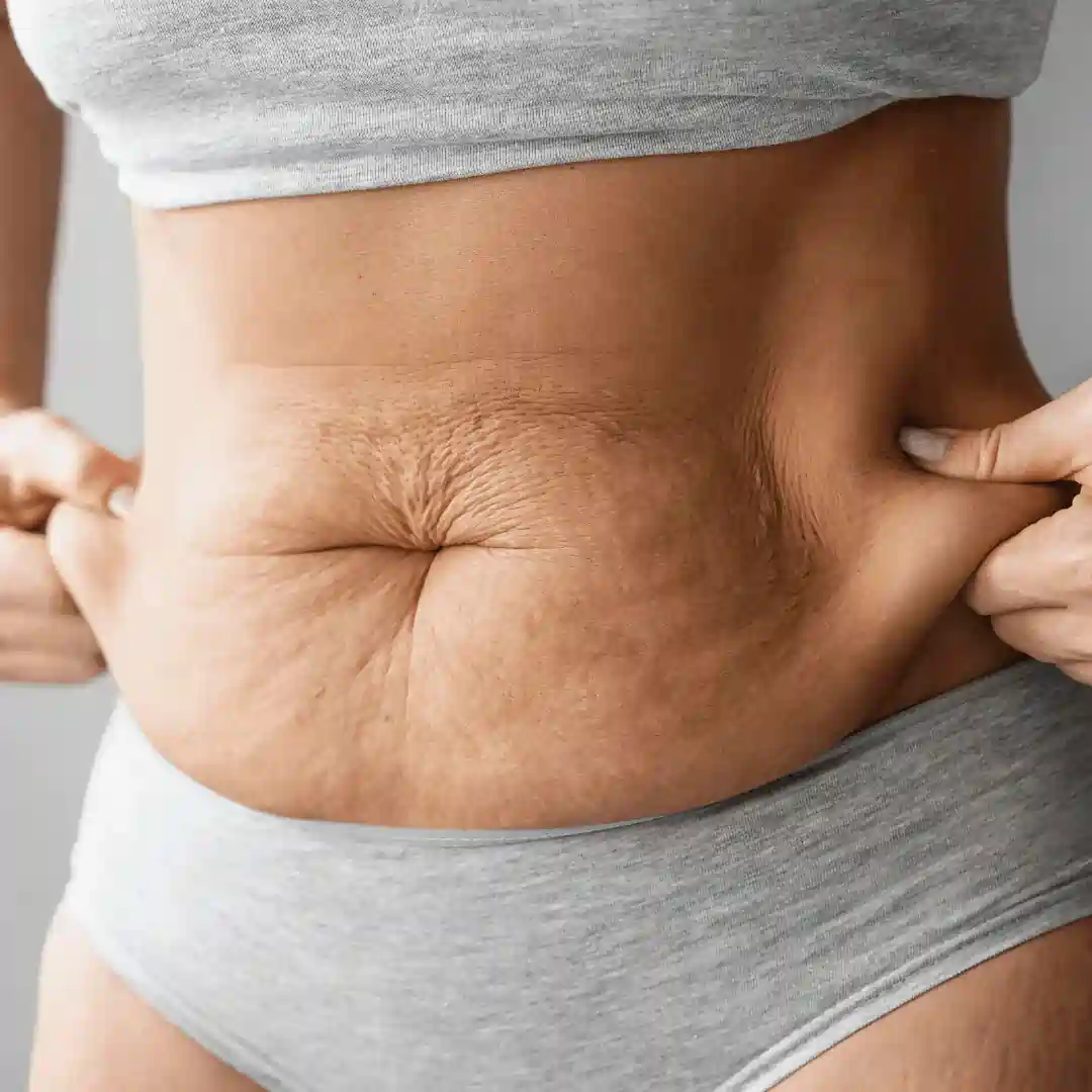 Is It Normal to Have Loose Skin After Pregnancy Shoreham Beach?